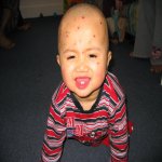 John Klein a la varicelle